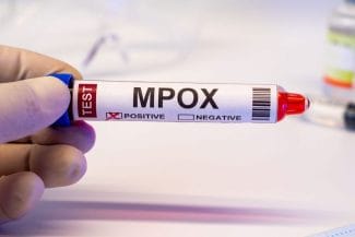 media-172804355563432700.jpg - Știri de azi Știri de azi | Primul caz de mpox confirmat în regiunea Kosovo pacient internat în Serbia - Știri de azi |