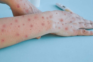 Știri de azi | Franţa detectează primul caz de nouă variantă mpox - Știri de azi | 