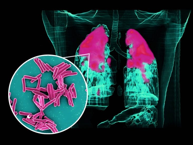 Știri de azi | OMS trage un semnal de alarmă! Creștere alarmantă a cazurilor de tuberculoză infantilă – Ce arată raportul - Știri de azi | 