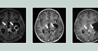 Știri de azi | Tumora cerebrală a unui bărbat a dispărut după administrarea unui medicament revoluţionar, în cadrul unui studiu clinic - Știri de azi | 