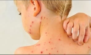 media-150487582913814300jpg - Știri de azi Știri de azi | Britanicii nu se mai vaccinează: Un copil din Liverpool a murit de rujeolă - Știri de azi |