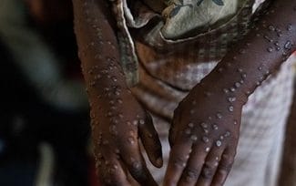 Știri de azi | Un prim deces din cauza mpox, înregistrat în epidemia din Ghana - Știri de azi | 