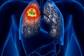 Știri de azi | Un nou tratament pentru cancerul pulmonar, autorizat prin procedură accelerată în SUA - Știri de azi | 