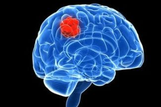 tumori-cerebralejpg - Știri de azi Știri de azi | Oamenii de ştiinţă au creat materiale „vii” din ADN capabile să recunoască tumorile şi să elibereze tratamente ţintite - Știri de azi |