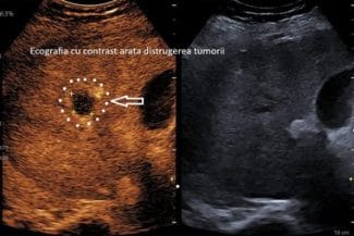 Știri de azi | Spitalul Clinic Judeţean de Urgenţă Craiova anunţă realizarea primei ablaţii cu microunde a unei tumori hepatice / La doar o lună după intervenţie, investigaţiile imagistice au confirmat distrugerea completă a tumorii - Știri de azi | 