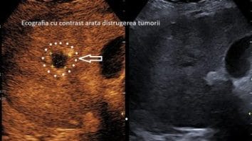 Știri de azi | Spitalul Clinic Judeţean de Urgenţă Craiova anunţă realizarea primei ablaţii cu microunde a unei tumori hepatice / La doar o lună după intervenţie, investigaţiile imagistice au confirmat distrugerea completă a tumorii - Știri de azi | 