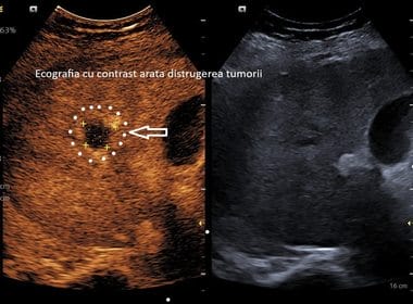 Știri de azi | Spitalul Clinic Judeţean de Urgenţă Craiova anunţă realizarea primei ablaţii cu microunde a unei tumori hepatice / La doar o lună după intervenţie, investigaţiile imagistice au confirmat distrugerea completă a tumorii - Știri de azi | 