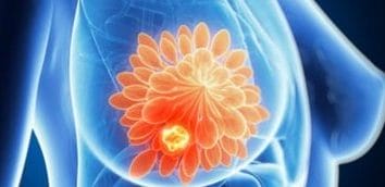 Știri de azi | O nouă potenţială abordare de tratament pentru cancerul de sân agresiv - Știri de azi | 