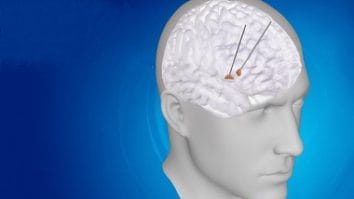 Știri de azi | Cercetătorii au identificat tipare neuronale în creier cu ajutorul cărora pot urmări evoluţia bolii Parkinson - Știri de azi | 