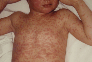 rujeola-twpng - Știri de azi Știri de azi | Canada pierde statutul de ţară fără rujeolă după o epidemie care a început în partea de est a ţării, în octombrie 2024, legată de un grup religios - Știri de azi |