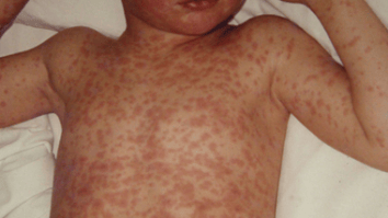 Știri de azi | Canada pierde statutul de ţară fără rujeolă după o recrudescenţă mortală legată de un grup religios - Știri de azi | 